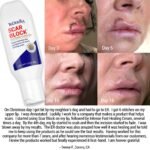 Scar Block Silicone Gel for New and Old Scars - Image 3